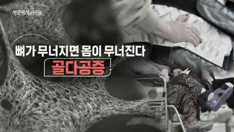 골다공증